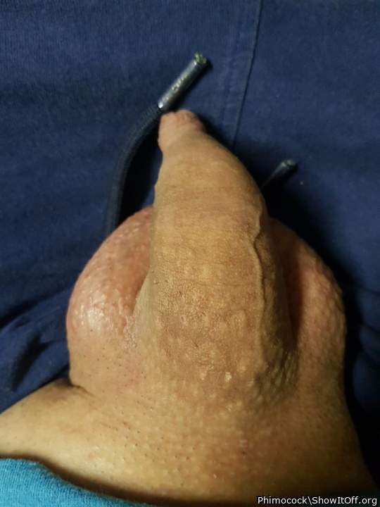 Wow, horny foreskin.    