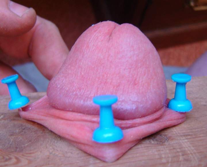 Foreskin pegged out