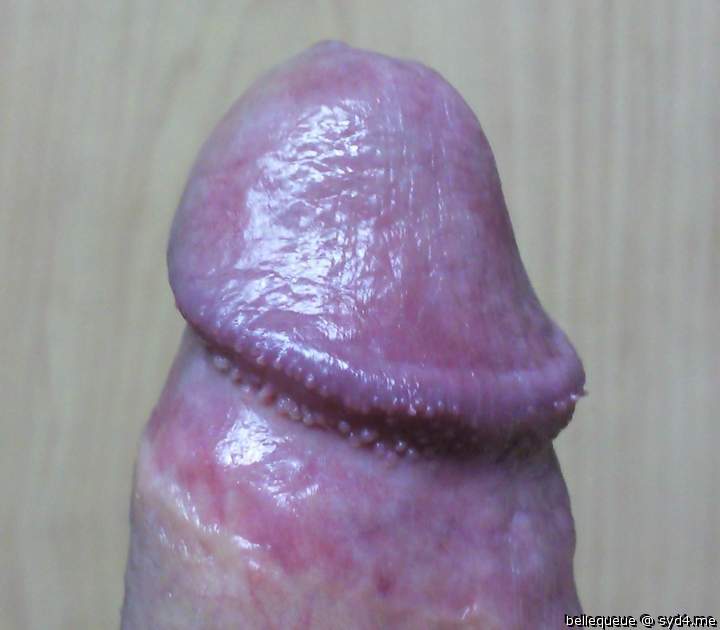 Amazing head papules! Love it!