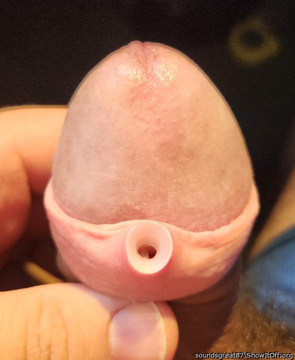 Foreskin Buttonhole in progress (2ga, 6mm)