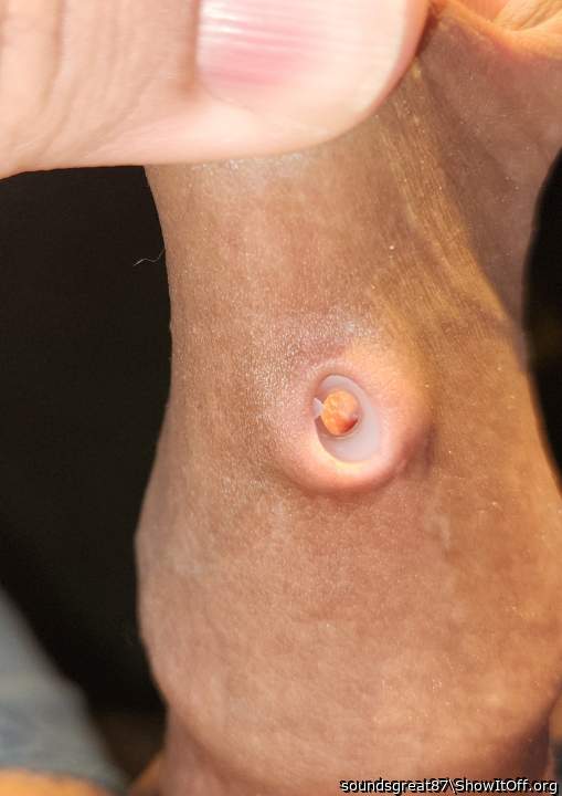 Foreskin Buttonhole in progress (2ga, 6mm)
