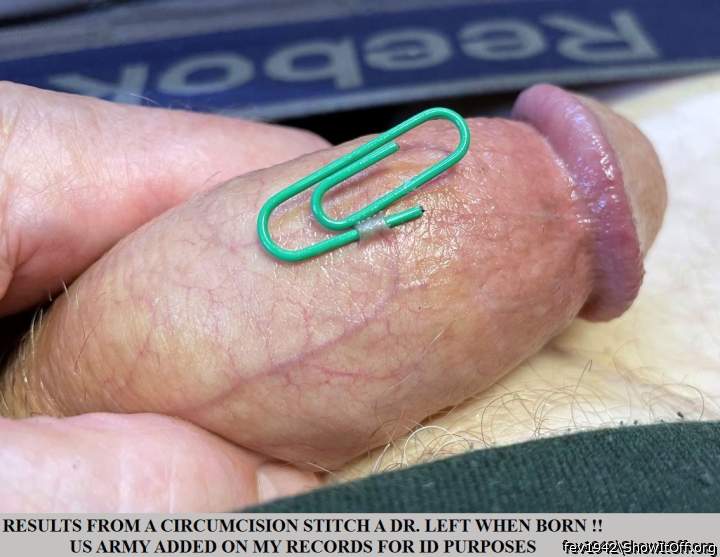CIRCUMCISION STITCH