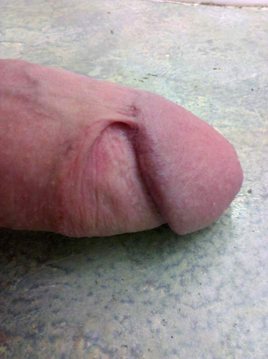 I also have a small skin bridge over my frenulum & I use it 