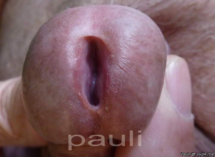 Open orifice