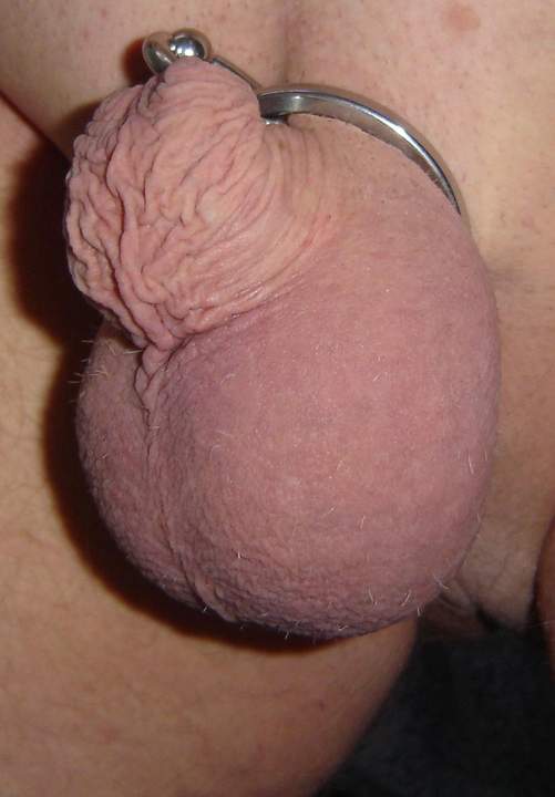 Foreskin infibulated upwards