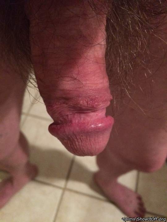 Nice circ scar line  