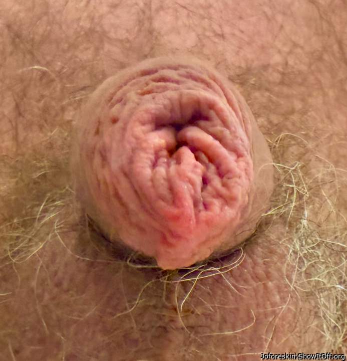 My foreskin