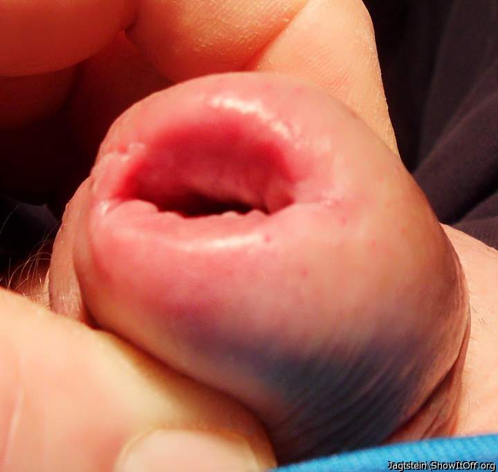 meatotomy after the sounden